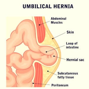 Hernia Chart